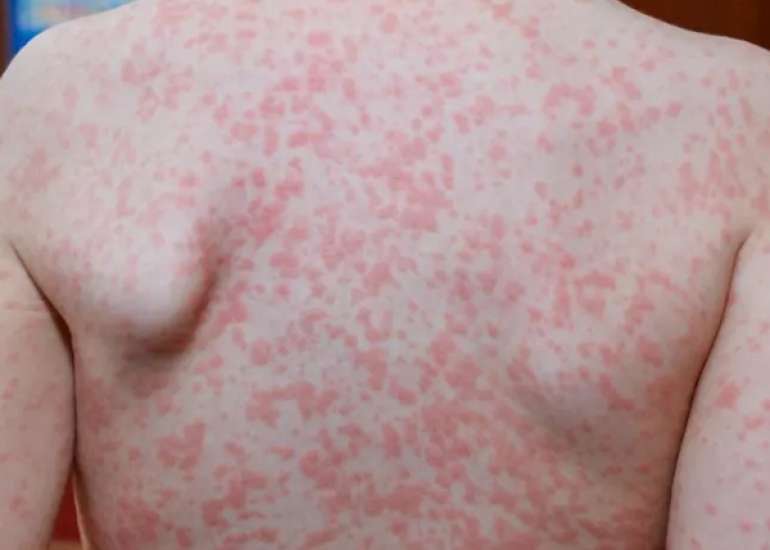 Disseminated life-threatening viral skin rash in a child with AD