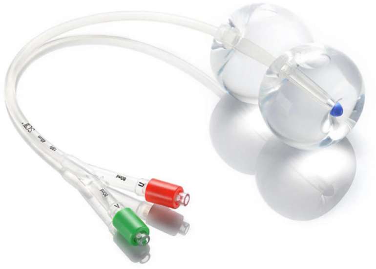 Double-balloon cervical ripening insertion for terminating CSP associated with low morbidity