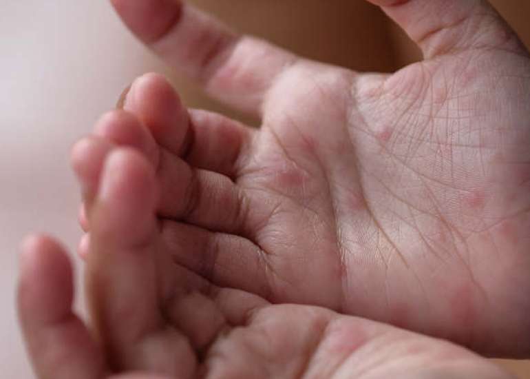 Doxycycline Phototoxicity in a Traveler