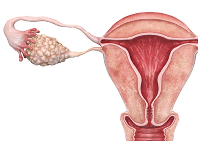 ESGO/ISUOG/IOTA/ESGE Consensus Statement on pre-operative diagnosis of ovarian tumors