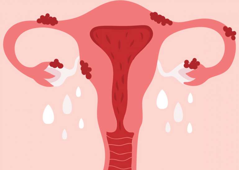 ESHRE guideline: endometriosis†