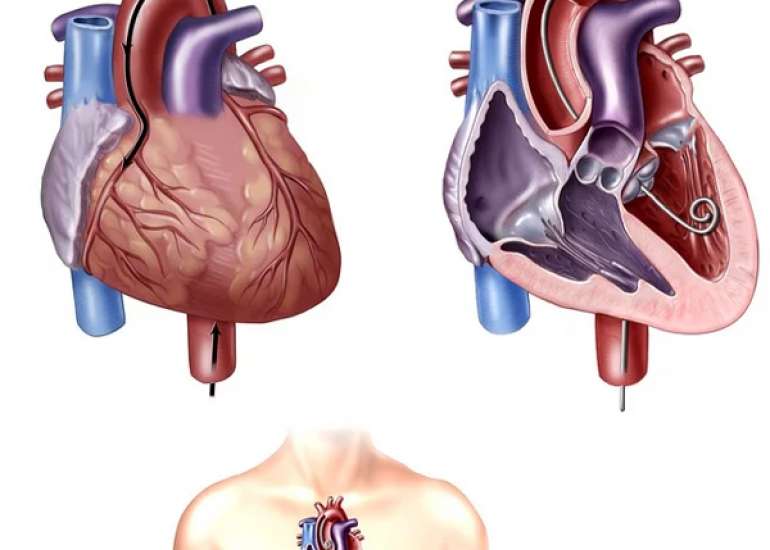 Early restenosis after primary PCI?