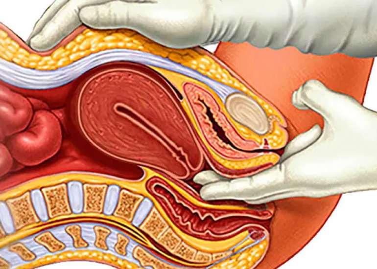Effects of Low Estrogens: Vaginal Atrophy
