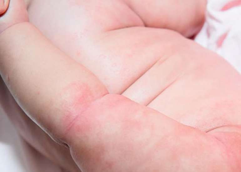 Effects of Topical Oils on Neonatal Skin