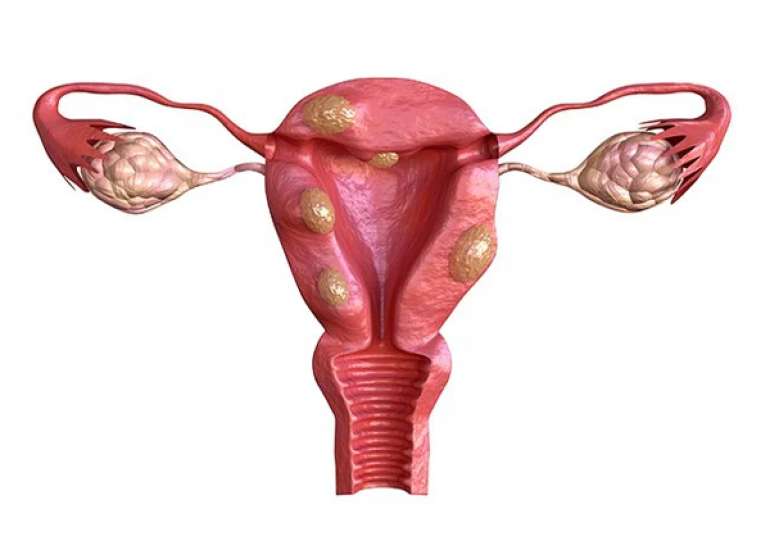 Embolization to Treat Uterine Fibroids with Bleeding and Severe Anemia
