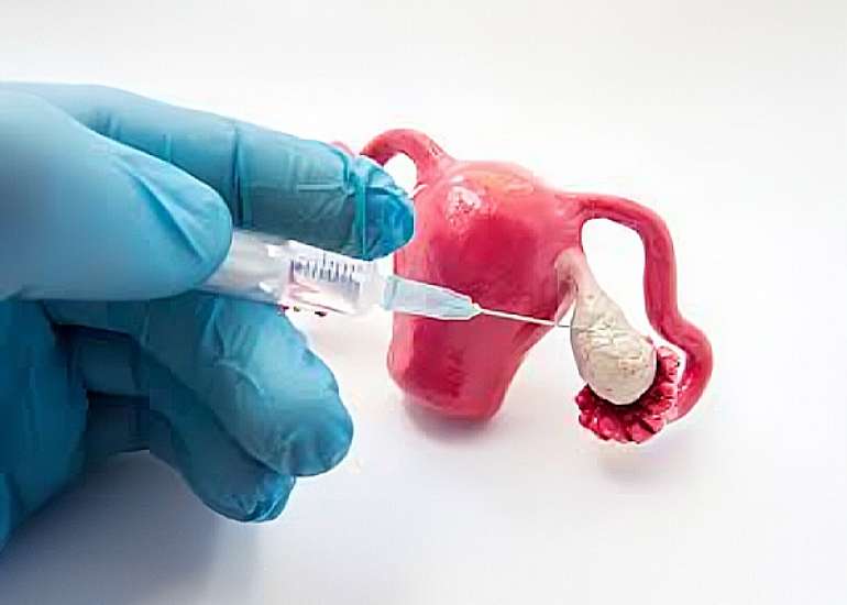 Embryo quality and pregnancy outcomes in patients with a low ovarian reserve regarding natural cycles Vs. Mildly stimulated cycles