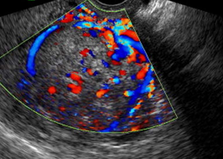 Endometrial Stromal Tumor Mimicking Fibroid Uterus 