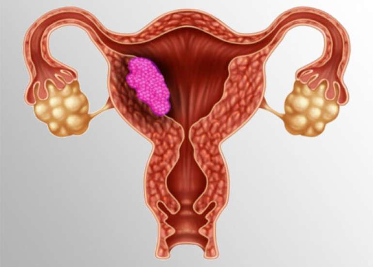 Endometrial carcinoma in a gravid uterus
