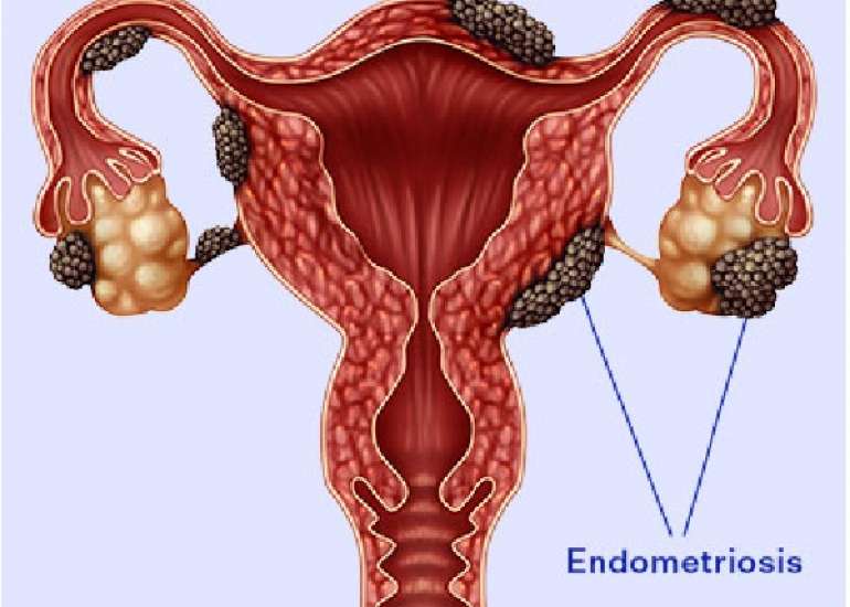 Endometriosis Pathogenesis: New Insights into Potential Therapies