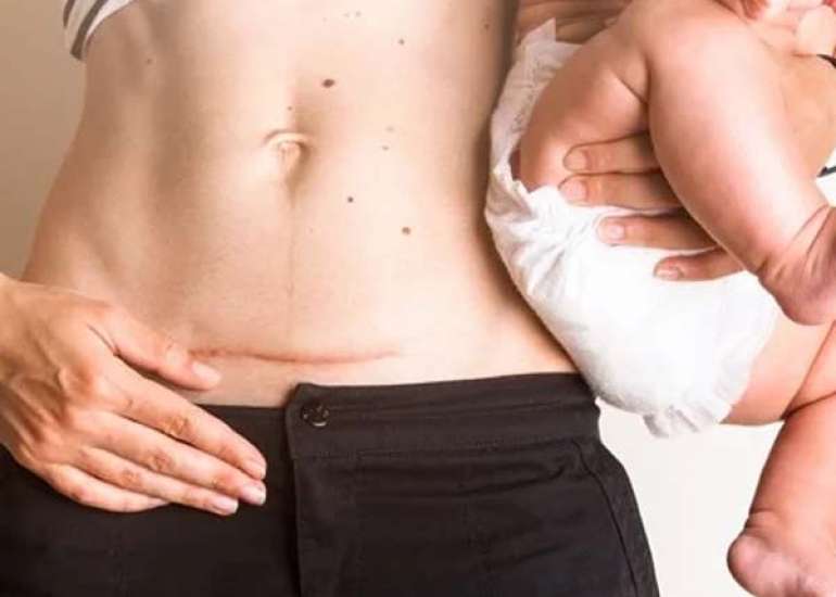 Enhancing Cesarean Safety for Gestational Diabetes Patients