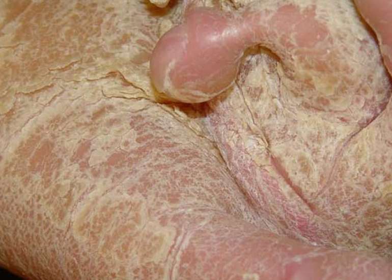 Epidermolytic Ichthyosis in a Neonate