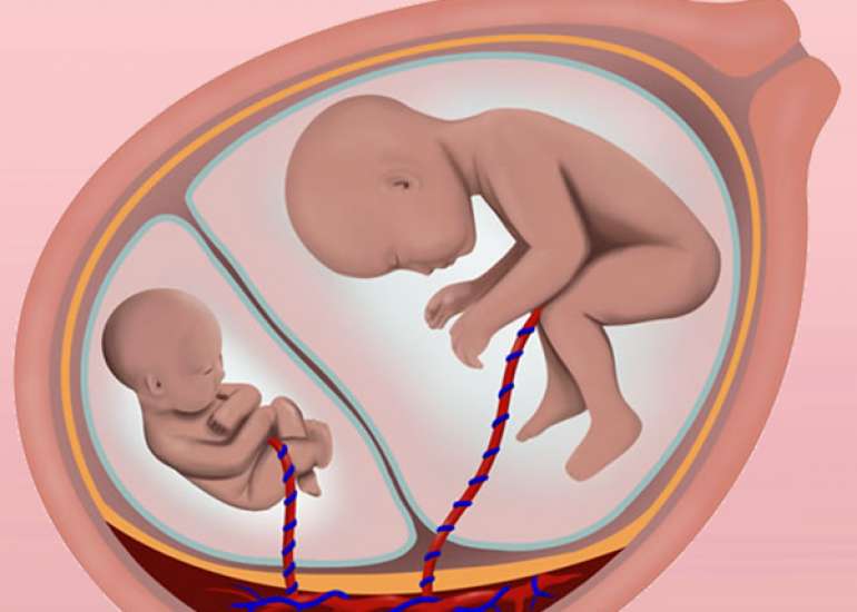 Evaluation and Management of Suspected Fetal Growth Restriction