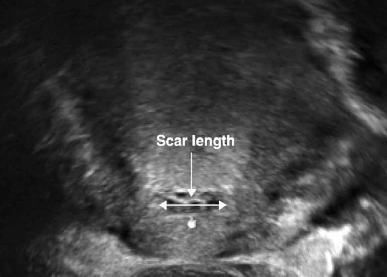 Evaluation of the Urinary Bladder Before Cesarean Delivery in Women with Multiple Abdominal Scars using Table Ultrasound Imaging