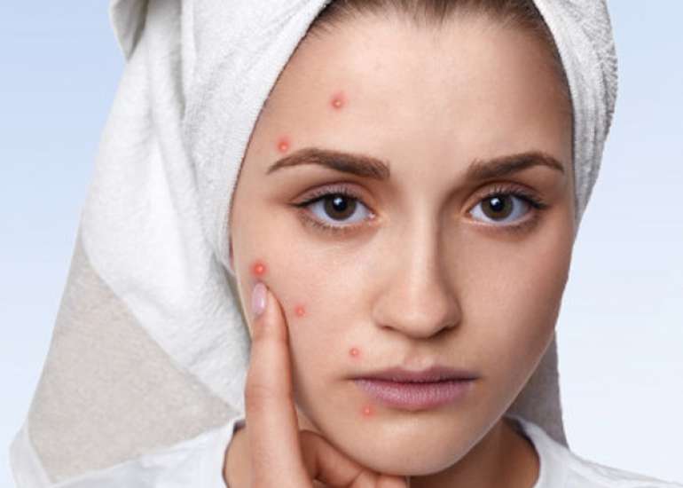 Know What causes Acne? Symptoms and Treatment 