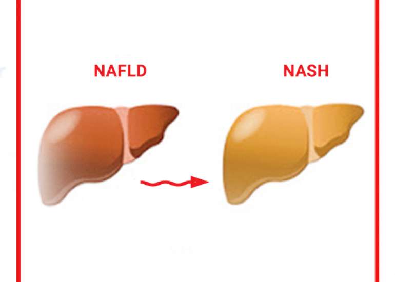 Understanding NASH and NAFLD: How do you differentiate?