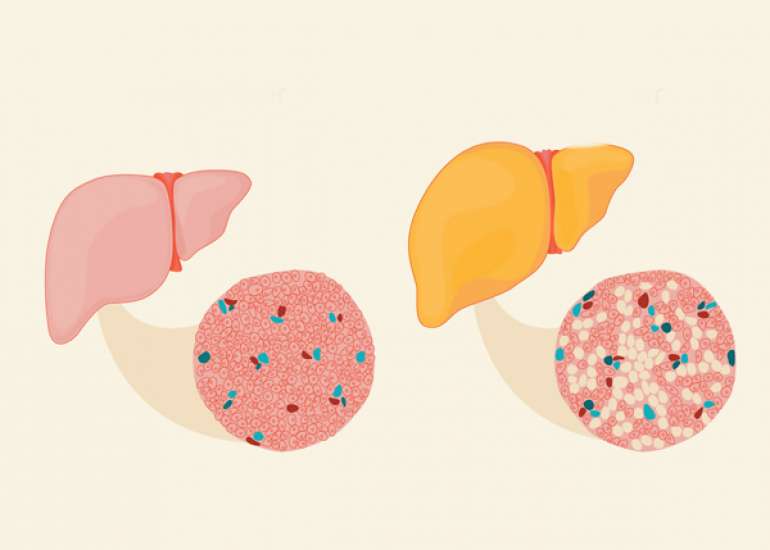 What is the Diet for Cirrhosis of the liver?