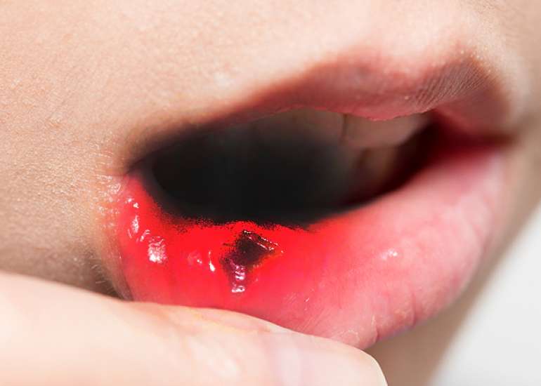 जानिए मुंह के कैंसर के शुरुआती लक्षण