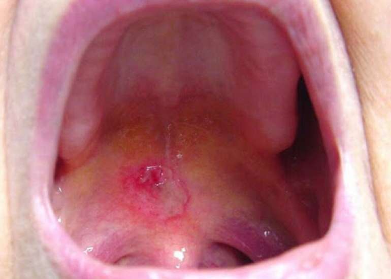  मुंह का कैंसर कैसे होता है  और कारण