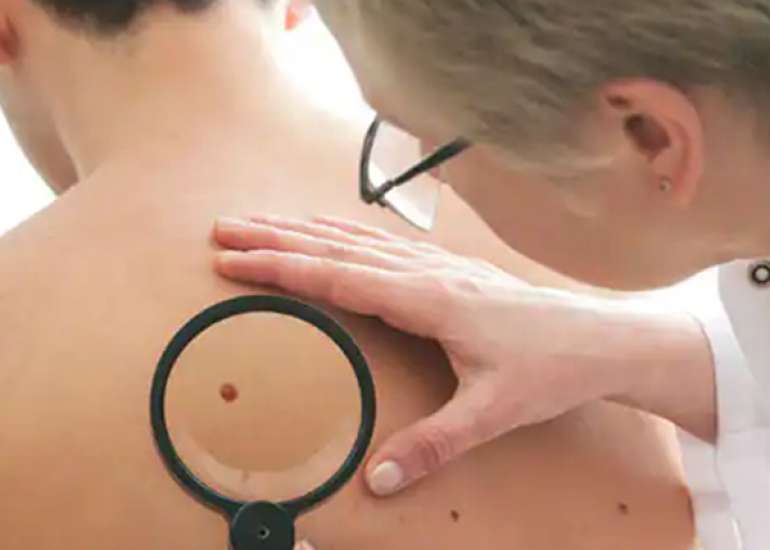 स्किन कैंसर - स्किन कैंसर क्यों होता है, लक्षण, इलाज, दवा 