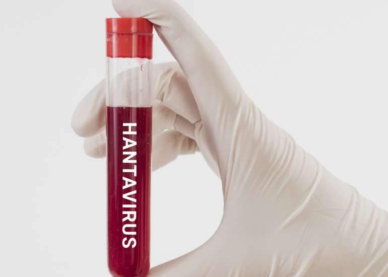 101 With Hantavirus: Causes, Symptoms And Treatment