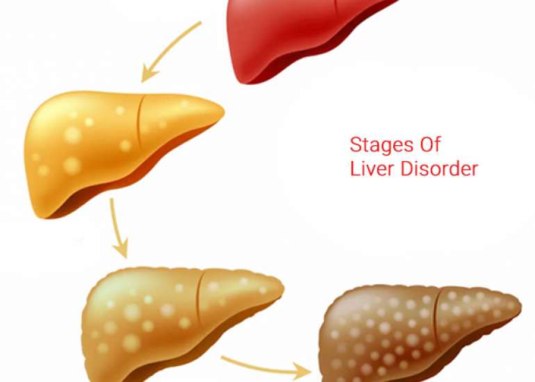 What are the stages of liver disease ?