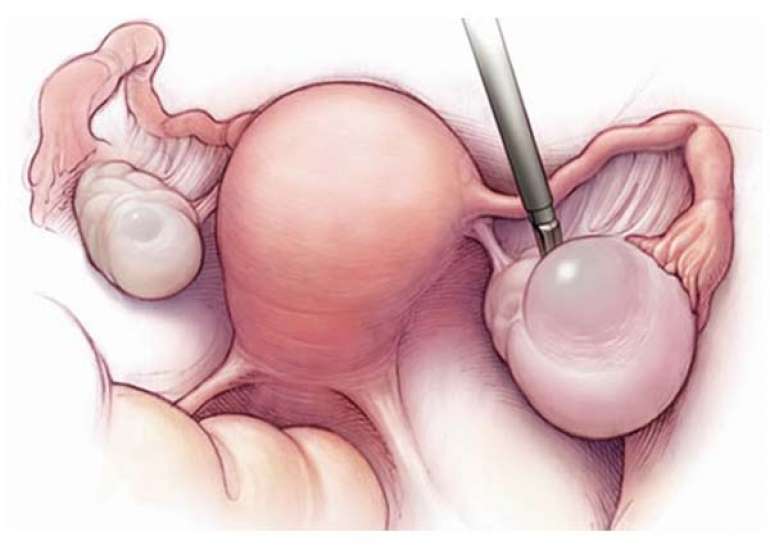 Fertility-Preserving Surgery for Granulosa Cell Tumor with a Teratoma