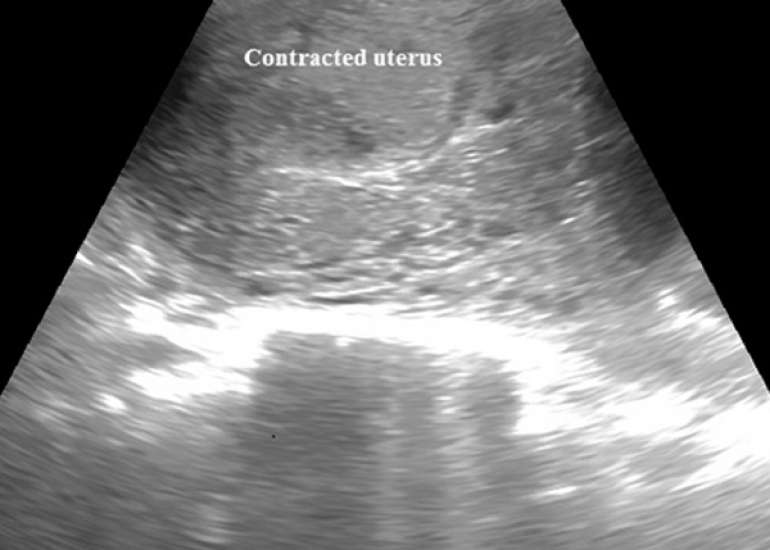 First-trimester uterine rupture: a case report