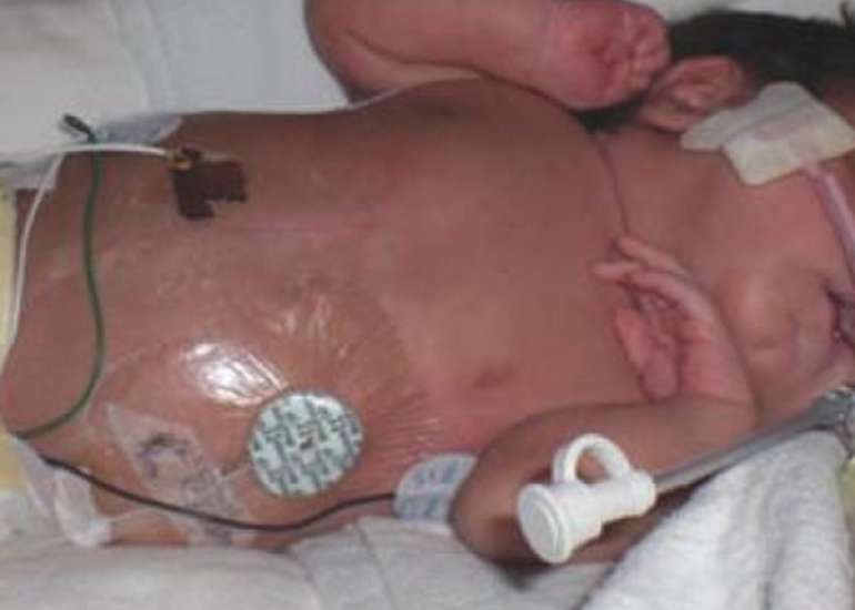 Fluid and Parenteral Nutrition Practices in Extreme Preterm Neonates in India