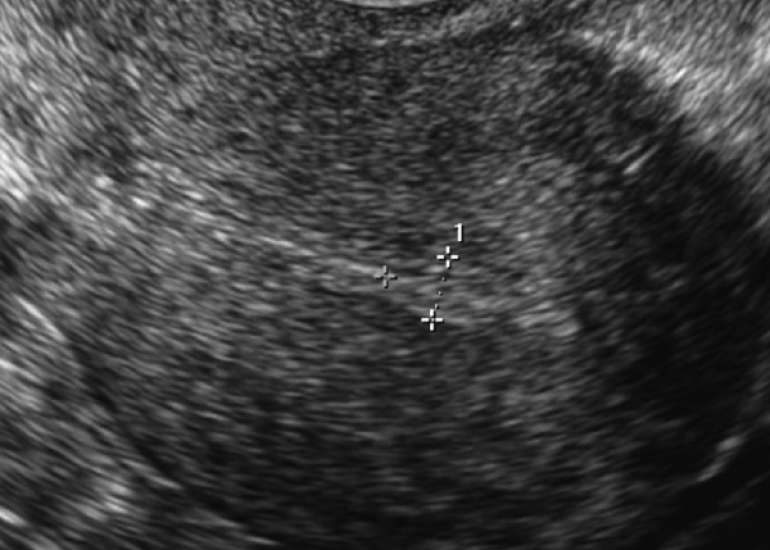 Frozen Embryo Transfer in Mildly Stimulated Cycles with Letrozole Combined with Estrogen in Women with Unresponsive Thin Endometrium Versus Standard Endometrial Preparation with Estrogen Alone