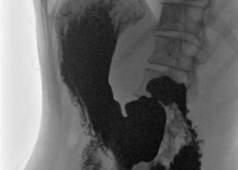 Gastroptosis as a Cause of Postprandial Abdominal Pain: A Case Report