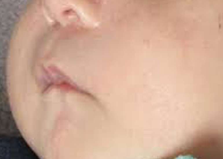 Genetic causes of neonatal and infantile hypercalcemia