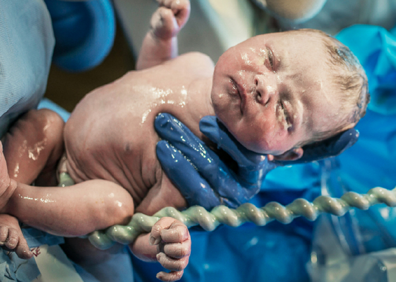 Relationship between umbilical cord arterial blood pH and meconium-stained liquor