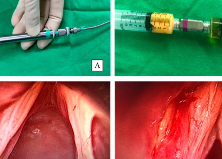 Intrauterine instillation of autologous platelet-rich plasma for boosting endometrial thickness and pregnancy result
