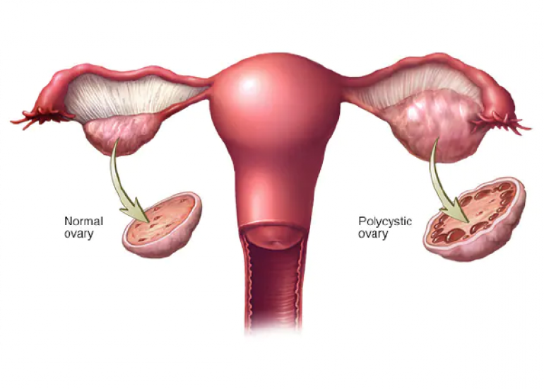 Inositol can effectively and safely manage polycystic ovary syndrome