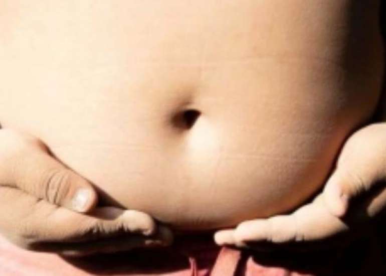 Health Burden Due to the Surge in Childhood Obesity in India