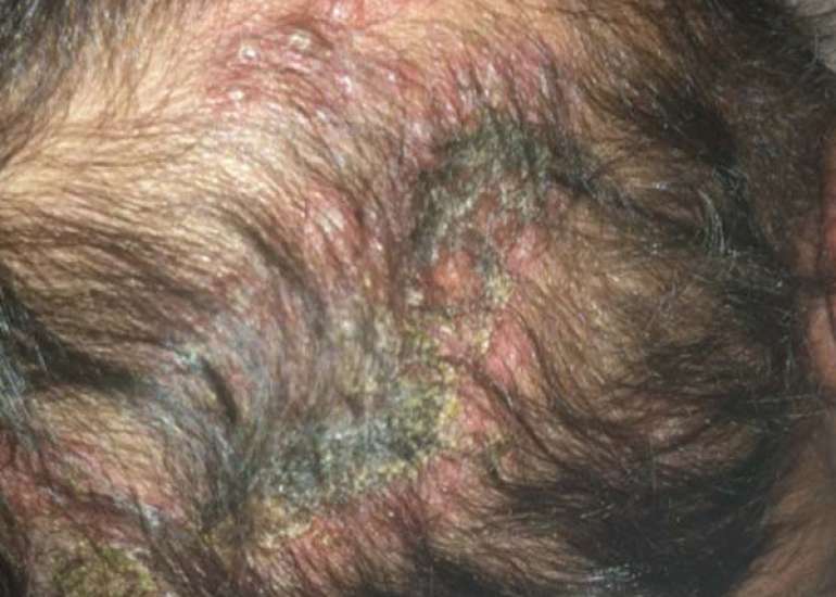 Herpes Simplex Encephalitis presentation in Infants and Toddlers: what should we expect?