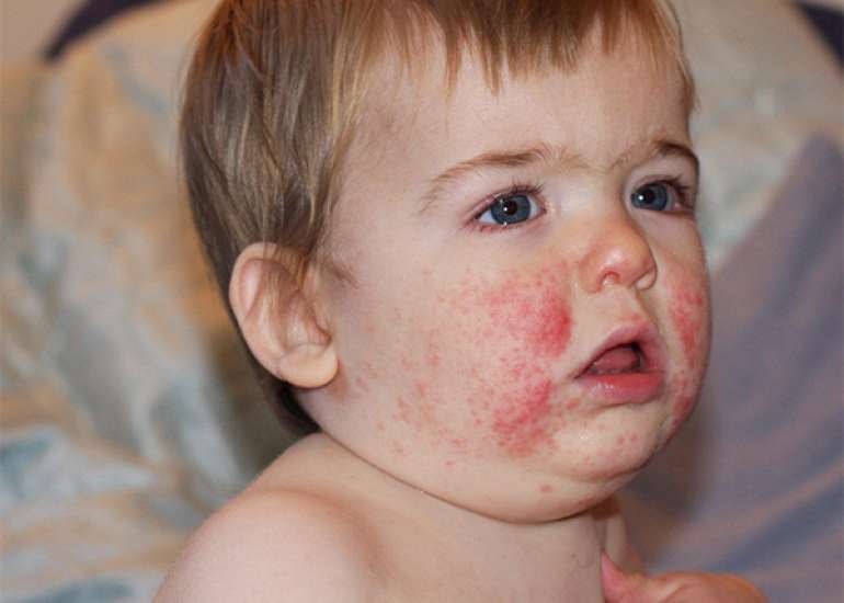 Herpes Zoster Ophthalmicus in Healthy 13-month Infant: An Unforeseen Scenario