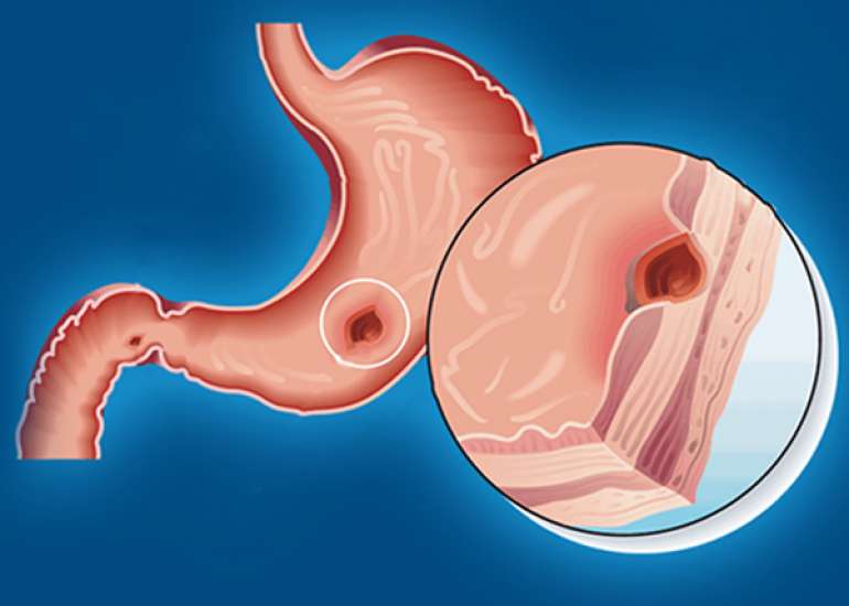 How can one evaluate peptic ulcer disease?