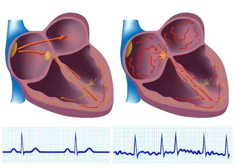 How common is atrial fibrillation in underlying rheumatic heart disease?