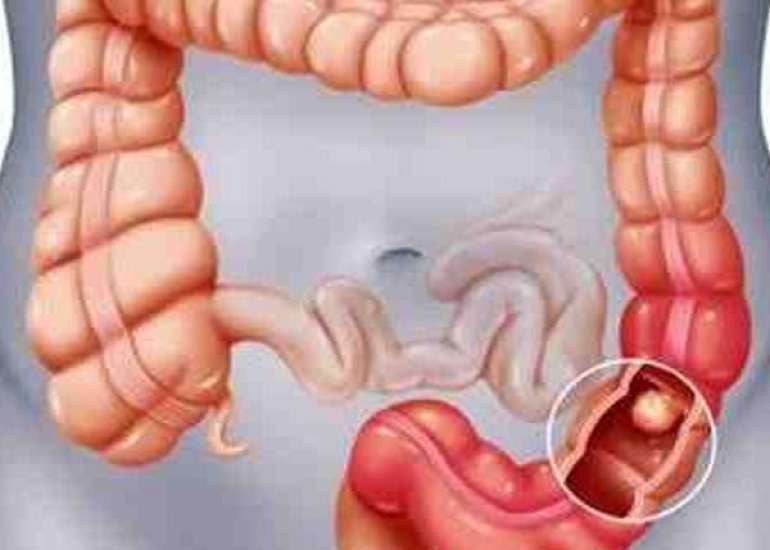 How common is cancer of the colon?
