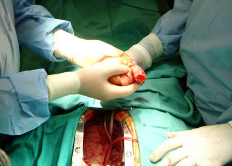 How difficult is cardiac transplant?