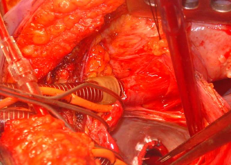 How difficult is it to redo bypass surgery?