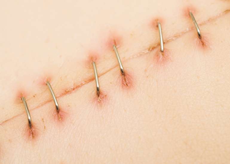 How to Heal Stitches faster?