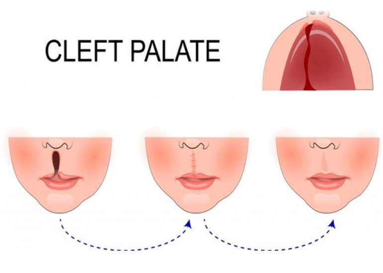How do you treat a Cleft lip and a Cleft Palate?