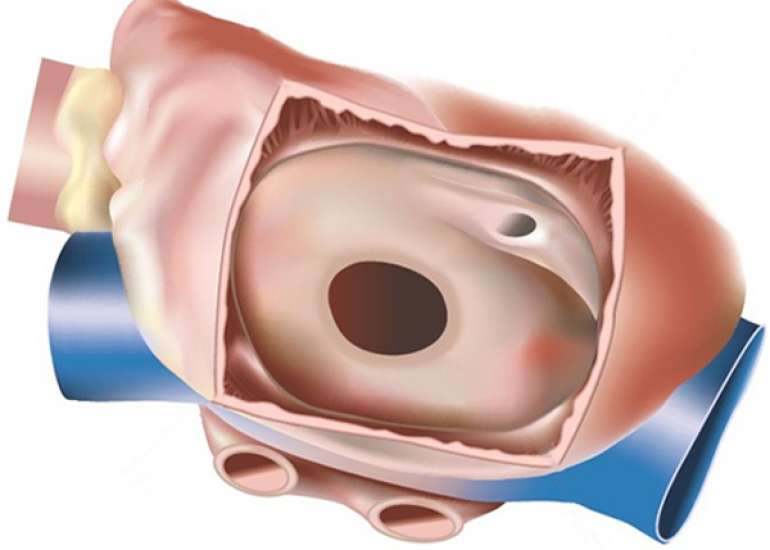How is ASD repaired?