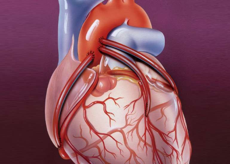 How is the need for heart bypass surgery determined?