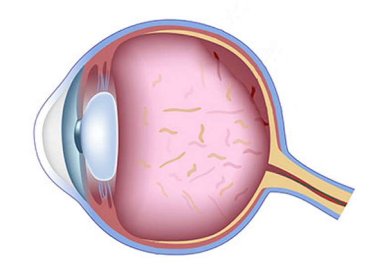 How is the retina examined?
