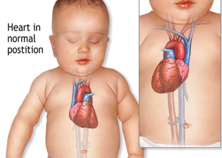 How rare is Dextrocardia?