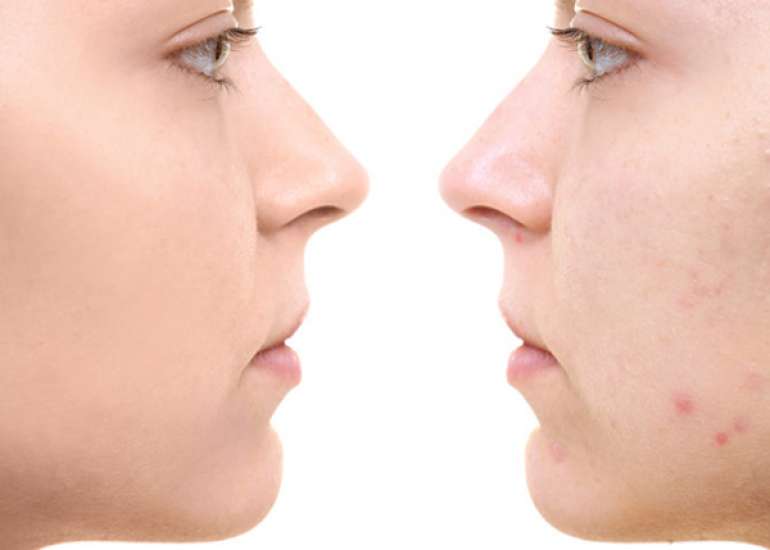 How to fade surgical scars ?