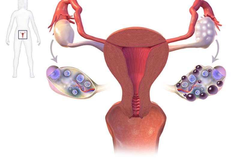 How should we proceed once we suspect PCOS?